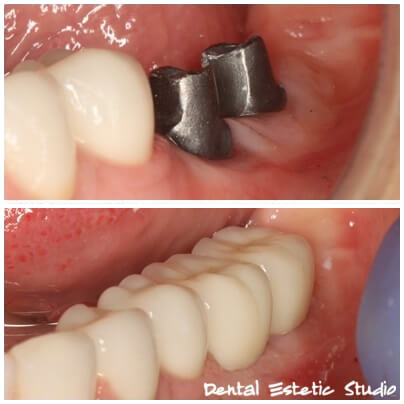implantati na zobeh