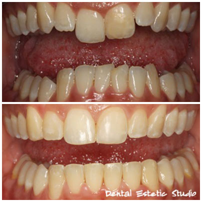 ortodoncija (zubni aparatići)